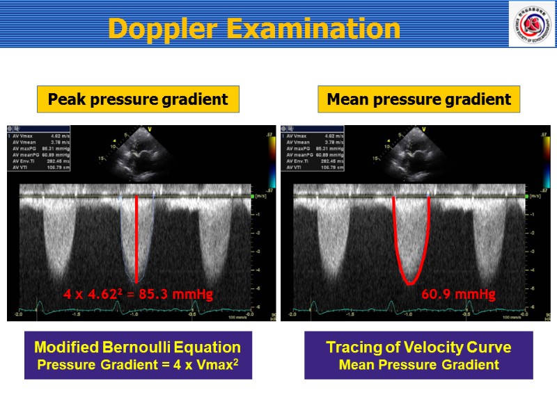 Peak pressure gradient  Mean pressure gradient  Modified Bernoulli Equation Pressure Gradient =